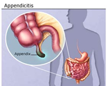 Appendicitis