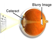 CataractSymptoms