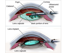 Cataracttreatment