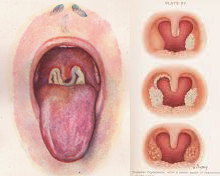 Diphtheria