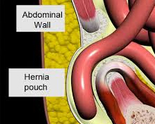 Hernia