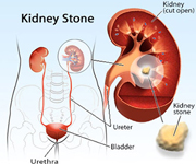 Kidney-Stones