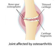 Osteoarthritis