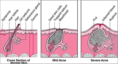 acne cause