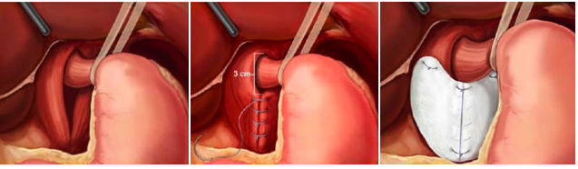 Hernia Operation