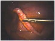 Digital Laparoscopic Camera