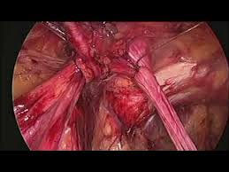 Laparoscopic cholecystectomy procedure
