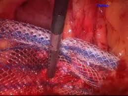 laparoscopic procedures