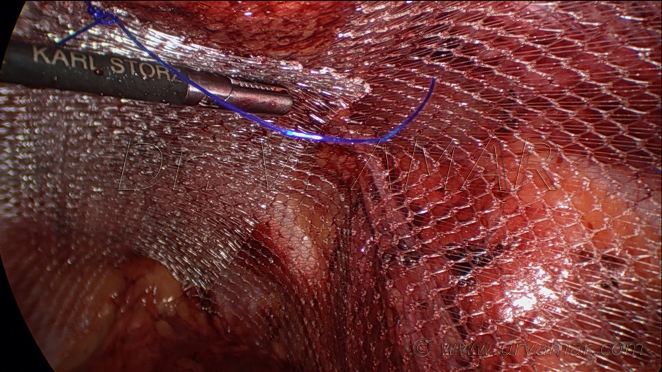 post laparoscopy care