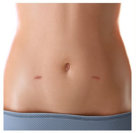 Scar after laparo surgery