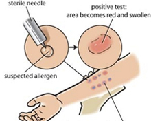 radioallergosorbent test 